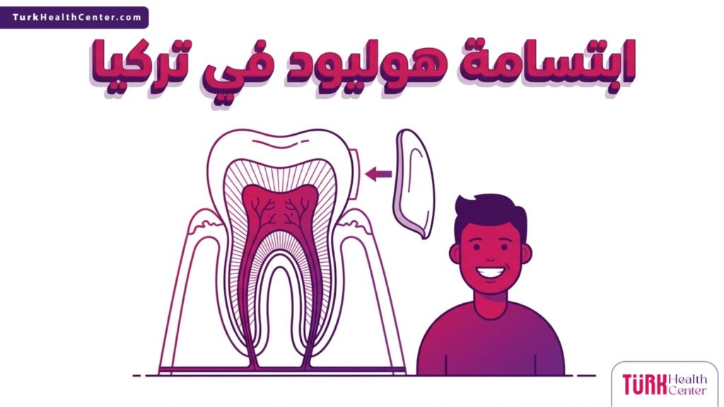 رسم توضيحي طبي ثلاثي الأبعاد يشرح آلية تركيب القشور الخزفية للحصول على ابتسامة هوليود في تركيا.