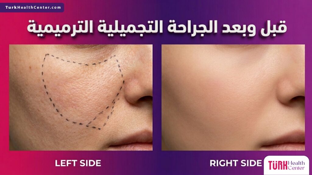 مقارنة قبل وبعد تظهر خطوط التخطيط الجراحي والنتيجة النهائية الشافية لعملية الجراحة التجميلية الترميمية.