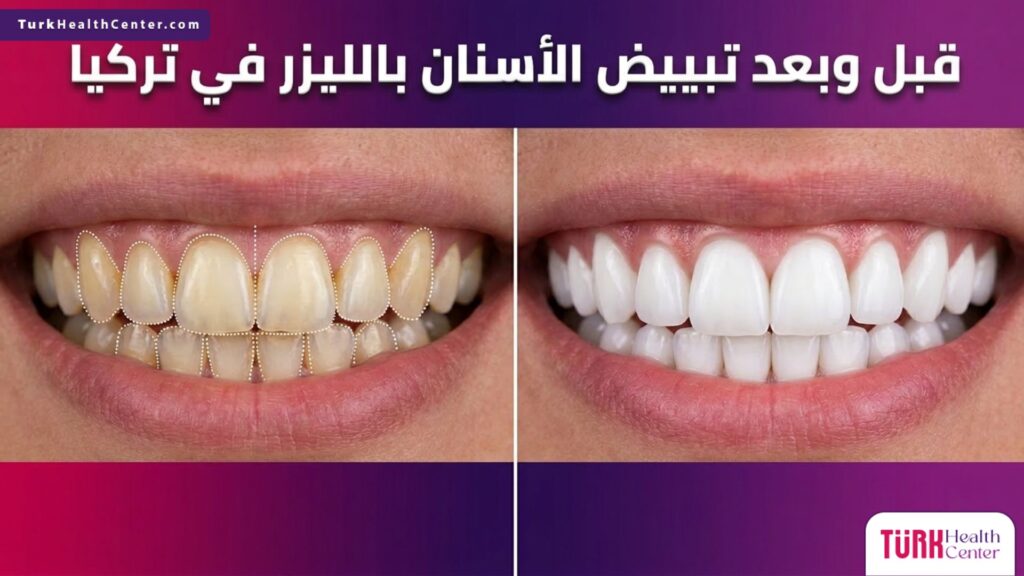 مقارنة قبل وبعد تبييض الأسنان بالليزر في تركيا تظهر الفرق الواضح في لون ولمعان الأسنان.