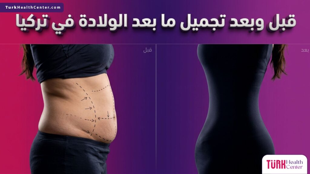 مقارنة قبل وبعد تجميل ما بعد الولادة في تركيا تظهر تحديد مسارات الجراحة التجميلية لمنطقة الخصر والبطن