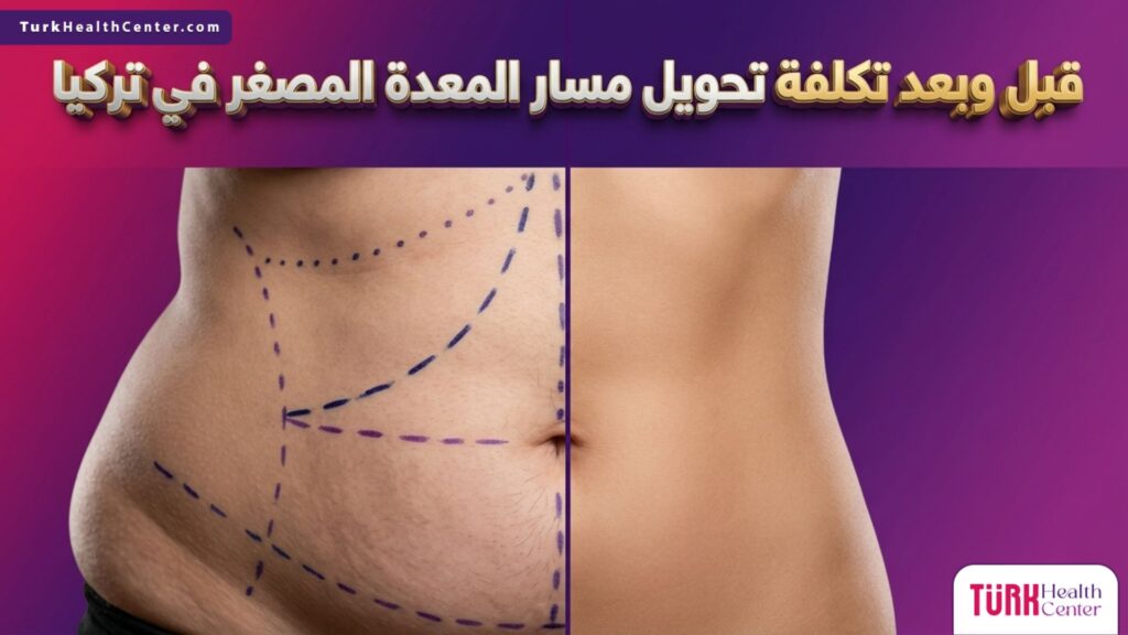 صورة مقسمة تظهر الفرق قبل وبعد جراحة السمنة مع نص يوضح تكلفة تحويل مسار المعدة المصغر في تركيا.