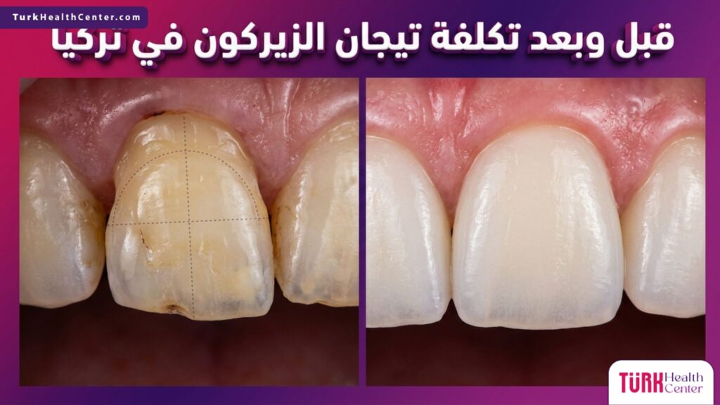 مقارنة قبل وبعد تركيب الأسنان توضح القيمة مقابل تكلفة تيجان الزيركون في تركيا مع إظهار النتيجة الجمالية الطبيعية.