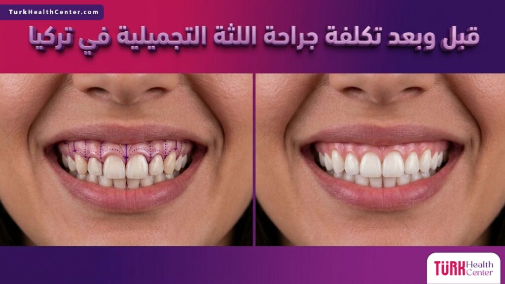 مقارنة قبل وبعد تظهر نتائج الابتسامة اللثوية مع نص قبل وبعد تكلفة جراحة اللثة التجميلية في تركيا.