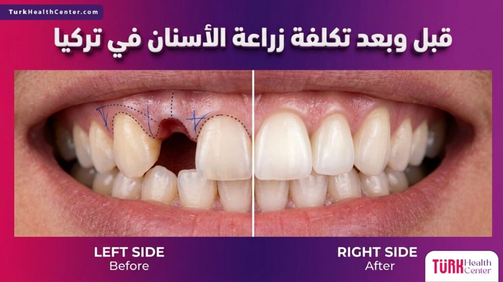 مقارنة قبل وبعد توضح نتائج الإجراءات ضمن تكلفة زراعة الأسنان في تركيا