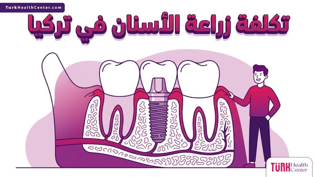 إنفوجرافيك تشريحي ثلاثي الأبعاد يوضح تركيب الزرعات ضمن تكلفة زراعة الأسنان في تركيا