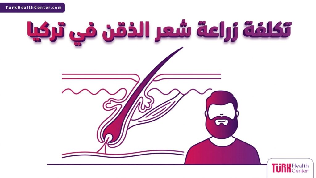 مخطط طبي تشريحي يوضح آلية زراعة البصيلات في الوجه المرتبطة ببحث تكلفة زراعة شعر الذقن في تركيا.