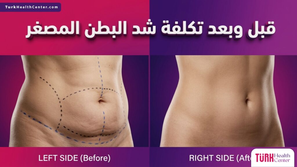 مقارنة قبل وبعد توضح نتائج العملية مقابل تكلفة شد البطن المصغر للتخلص من ترهلات أسفل البطن.