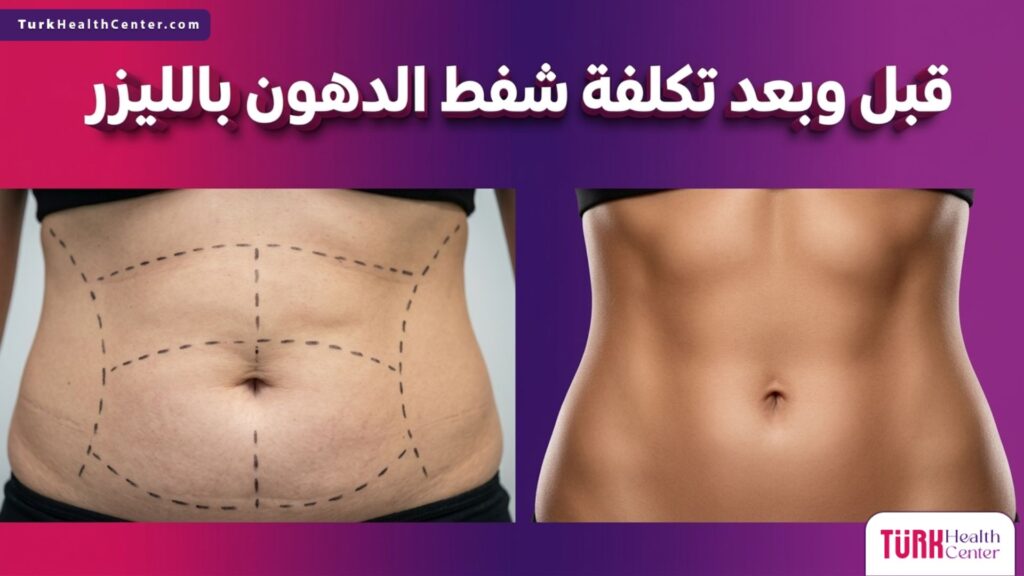 مقارنة قبل وبعد تبرز النتائج المذهلة وتبرر تكلفة شفط الدهون بالليزر في نحت قوام البطن.