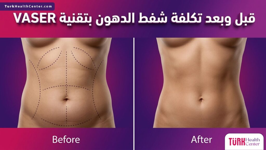 صورة مقارنة تظهر التغيير الجسدي قبل وبعد الإجراء لتوضيح تكلفة شفط الدهون بتقنية VASER بنجاح.