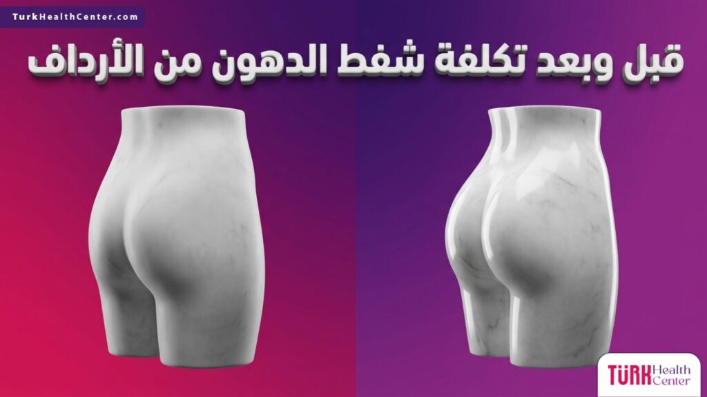 صورة مقارنة تظهر التغيير المتوقع قبل وبعد معرفة تكلفة شفط الدهون من الأرداف باستخدام تصميم مجسم فني فاخر.
