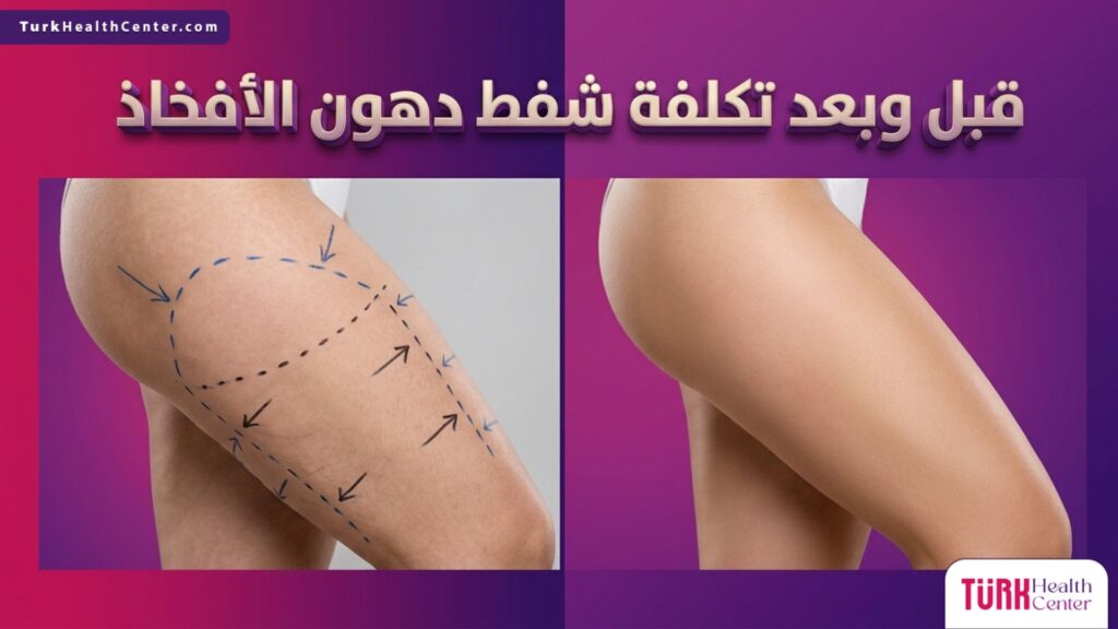 مقارنة قبل وبعد توضح النتائج الجمالية المرتبطة بـ تكلفة شفط دهون الأفخاذ مع علامات جراحية دقيقة.
