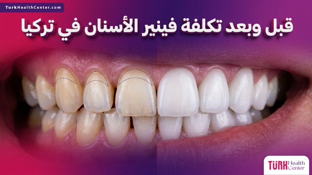 مقارنة قبل وبعد توضح نتائج و تكلفة فينير الأسنان في تركيا