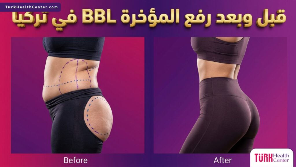 صورة قبل وبعد لنتائج عملية رفع المؤخرة BBL في تركيا تظهر تحديد الخصر وتكبير الأرداف