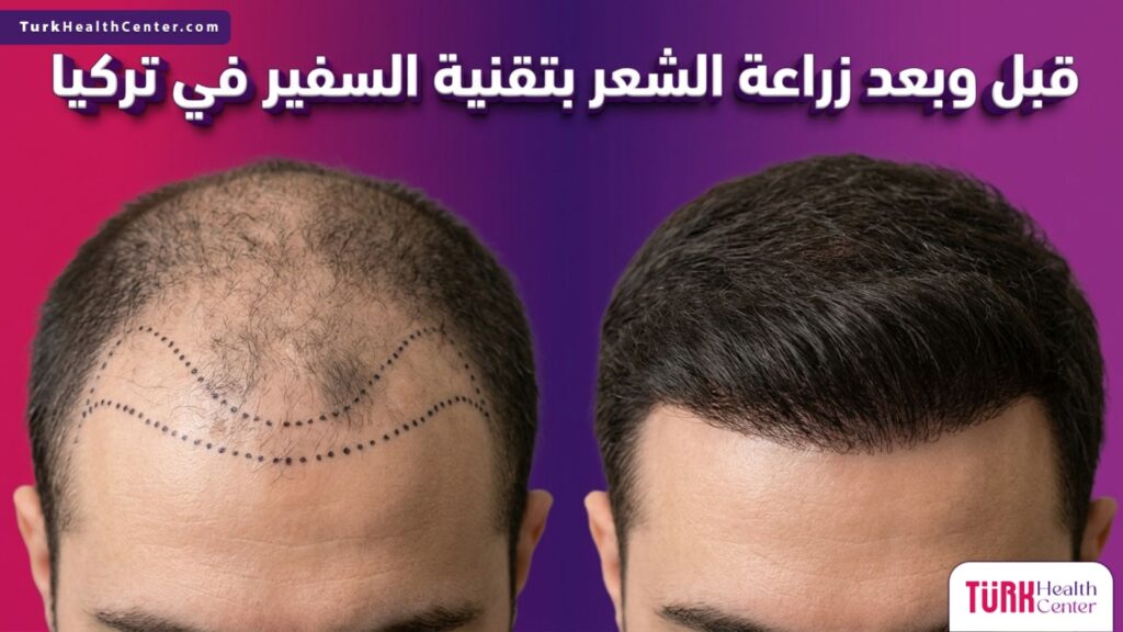مقارنة قبل وبعد زراعة الشعر بتقنية السفير في تركيا تظهر دقة التخطيط الطبي وكثافة النتائج النهائية.