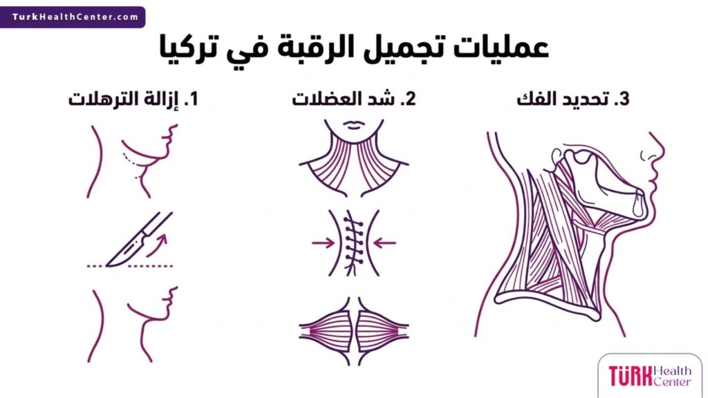 ملصق إنفوجرافيك تعليمي يلخص الفوائد والخطوات الثلاث الرئيسية في عمليات تجميل الرقبة في تركيا.