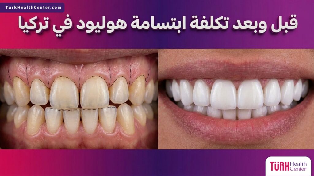 مقارنة قبل وبعد لنتائج علاج وتوضيح تكلفة ابتسامة هوليود في تركيا.