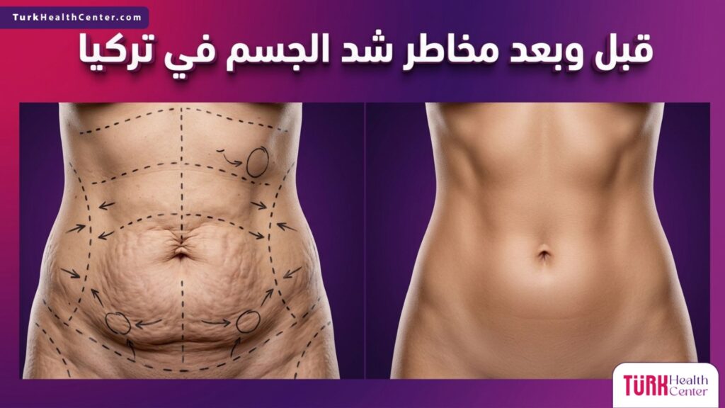 مقارنة قبل وبعد توضح النتائج الآمنة وتفادي مخاطر شد الجسم في تركيا بفضل التخطيط الجراحي السليم.