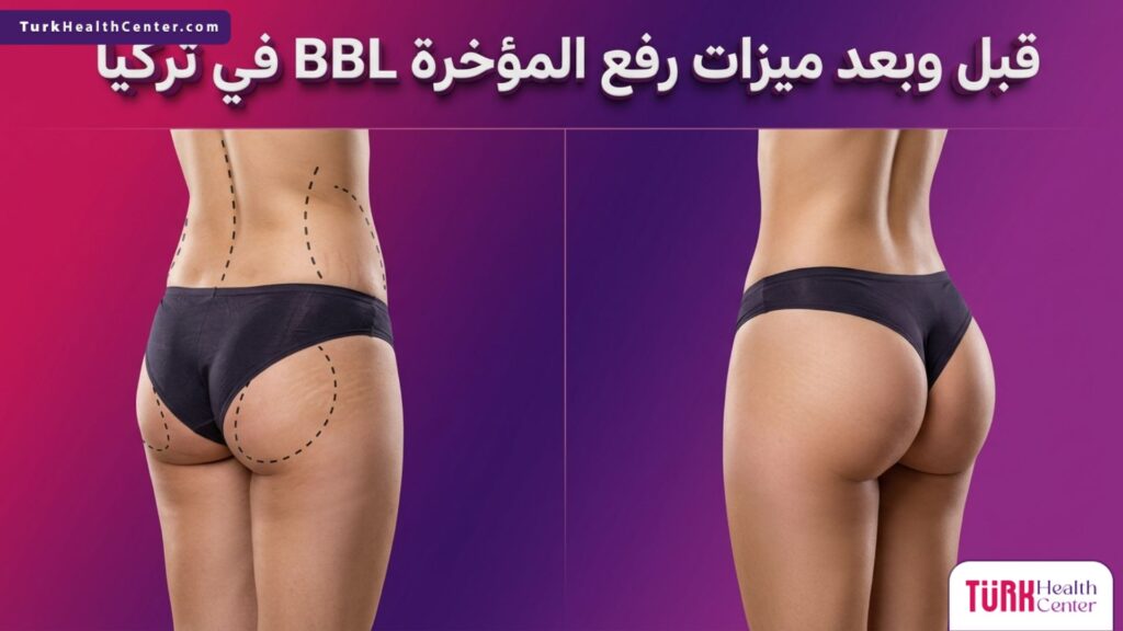 مقارنة قبل وبعد تظهر ميزات رفع المؤخرة BBL في تركيا وتحديد مسارات الجراحة التجميلية