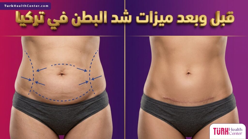 صورة مقسمة تظهر نتائج قبل وبعد توضح ميزات شد البطن في تركيا والتخلص من الترهلات.
