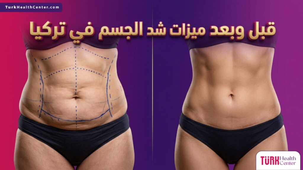صورة واقعية مقسمة تظهر نتائج قبل وبعد توضح ميزات شد الجسم في تركيا وإزالة الترهلات الجلدية.