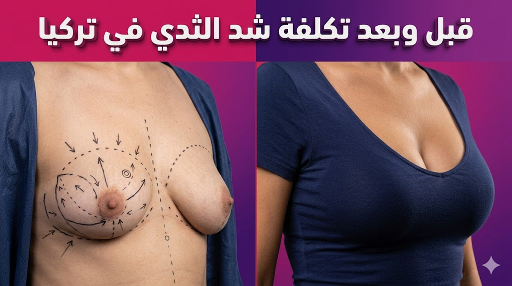  مقارنة قبل وبعد توضح نتائج العملية و تكلفة شد الثدي في تركيا مع خطوط جراحية توضيحية.