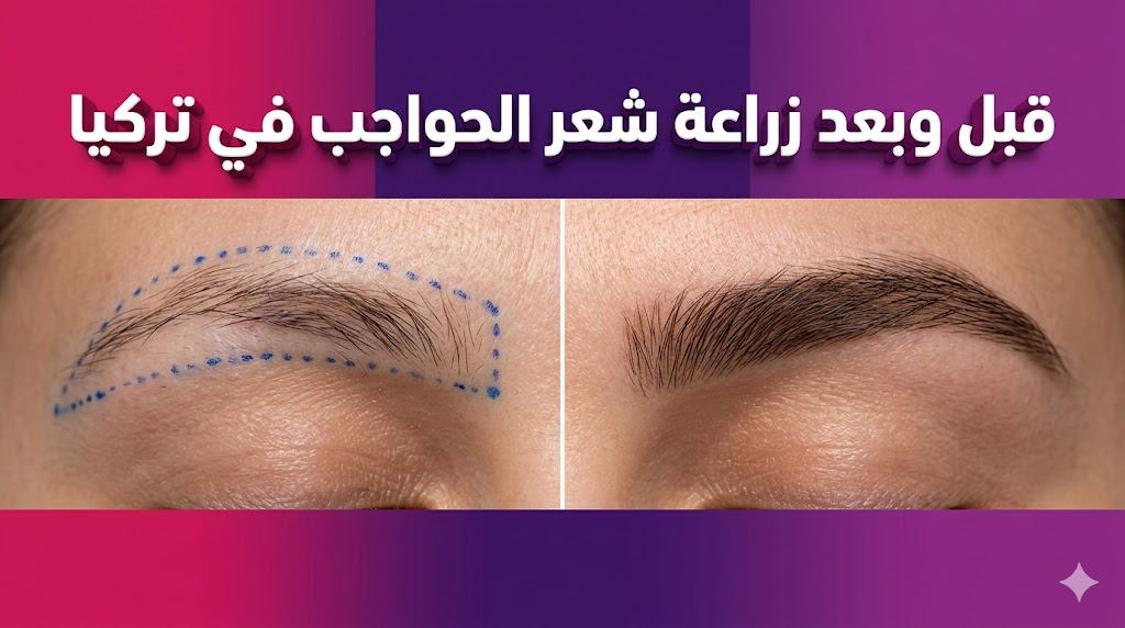  مقارنة واقعية قبل وبعد زراعة شعر الحواجب في تركيا تظهر الفرق في كثافة وشكل الحاجبين.
