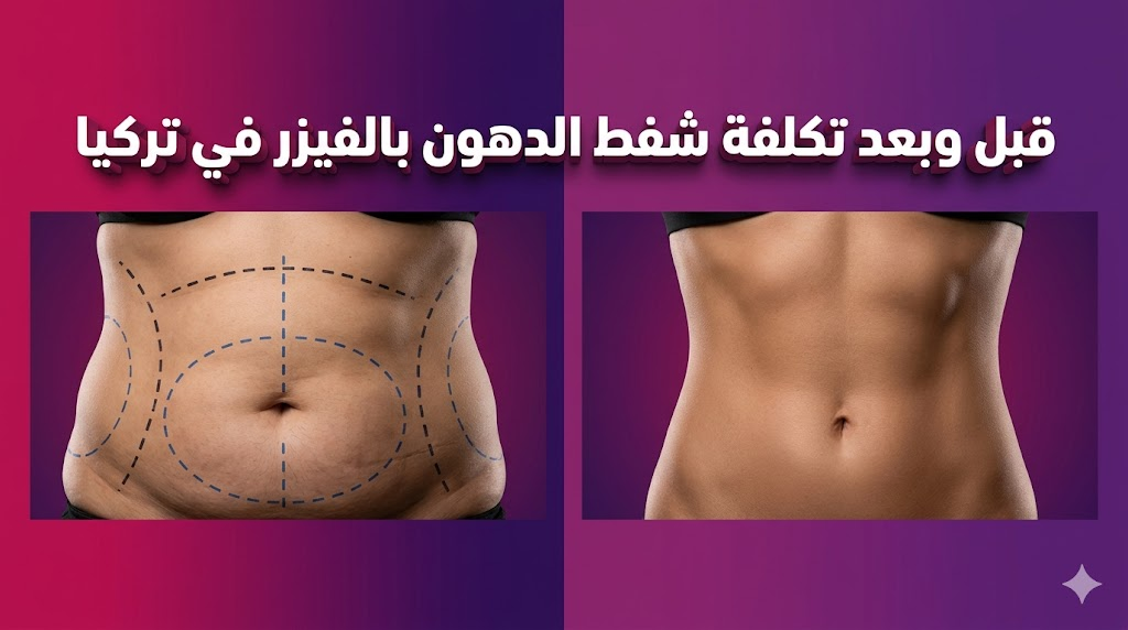  مقارنة قبل وبعد توضح نتائج تكلفة شفط الدهون بالفيزر في تركيا مع علامات التخطيط الجراحي والنتيجة النهائية.