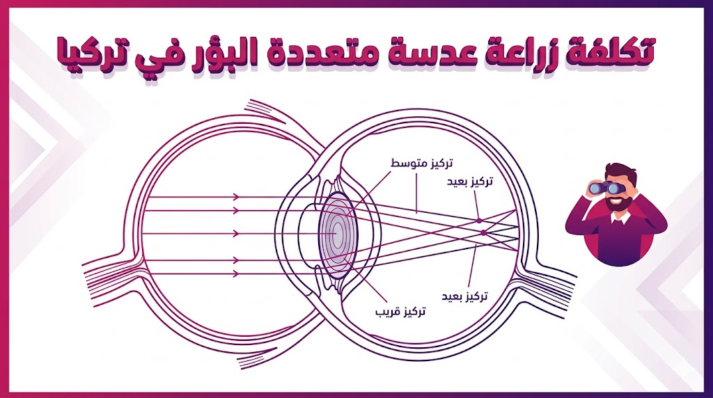 مخطط تشريحي يوضح تقنية و تكلفة زراعة عدسة متعددة البؤر في تركيا وكيفية استعادة الإبصار بدقة.