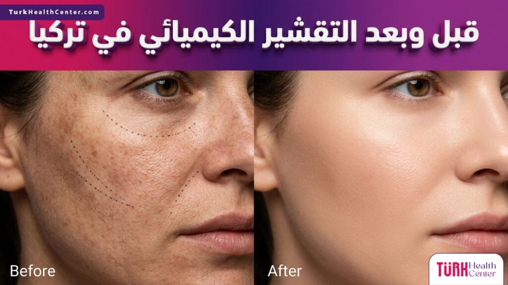 صورة مقسمة تبرز التحول المذهل في نضارة البشرة قبل وبعد التقشير الكيميائي في تركيا.