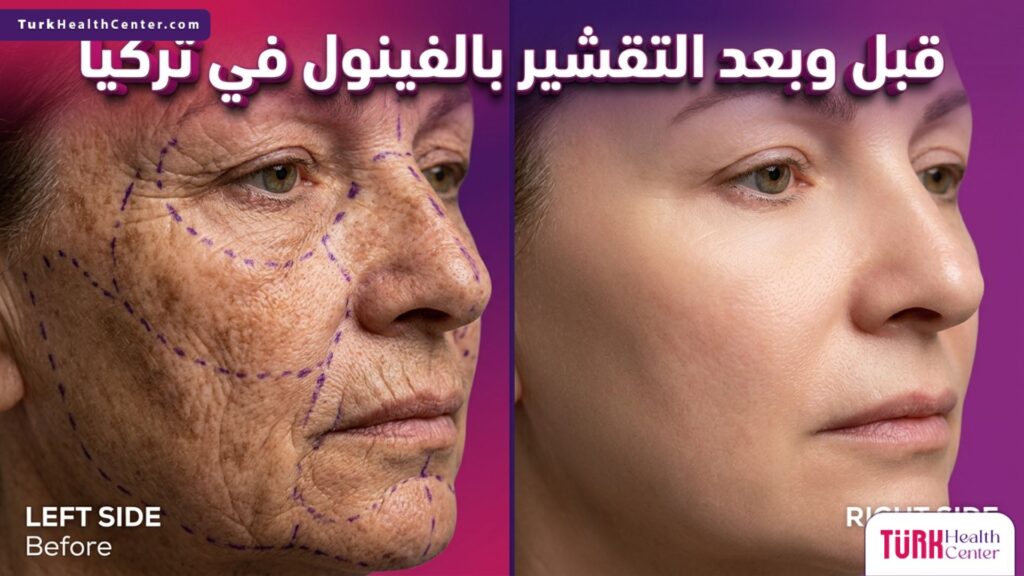 مقارنة قبل وبعد التقشير بالفينول في تركيا توضح التخلص من التجاعيد العميقة وتجديد شباب البشرة.