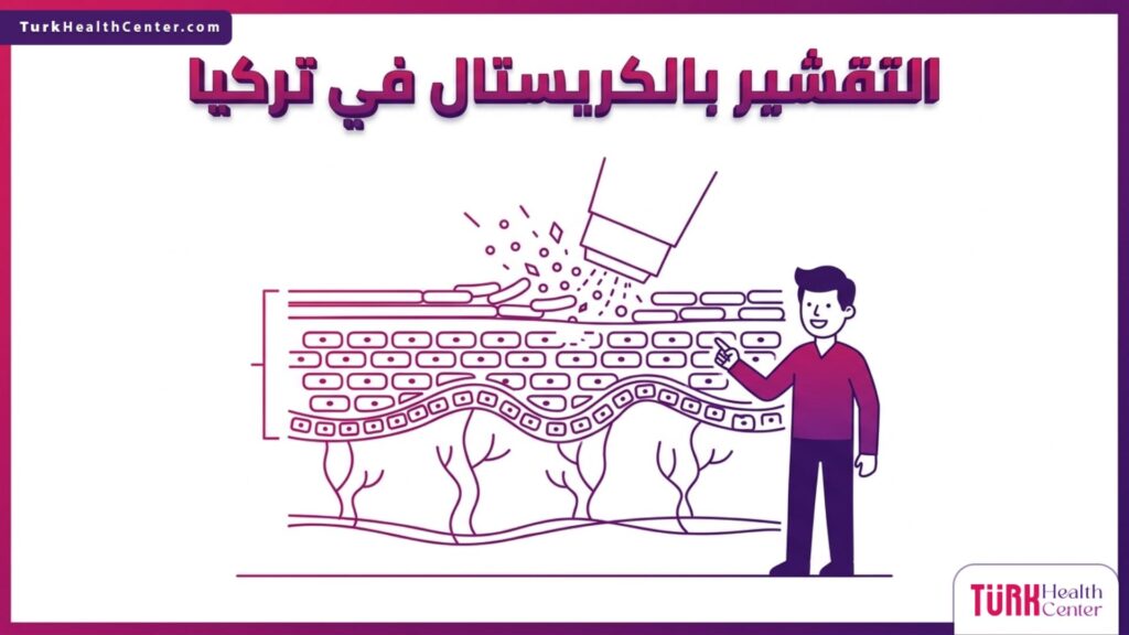 رسم تشريحي يوضح آلية عمل التقشير بالكريستال في تركيا على طبقات البشرة السطحية لإزالة الجلد الميت.