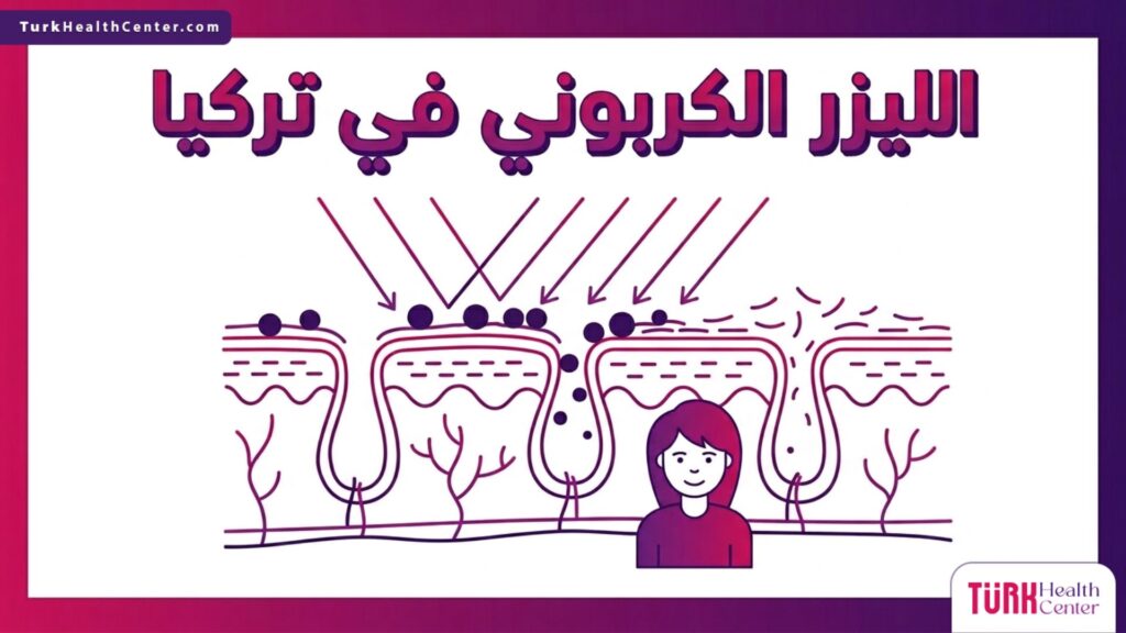 رسم توضيحي طبي لطبقات الجلد يشرح آلية عمل الليزر الكربوني في تركيا