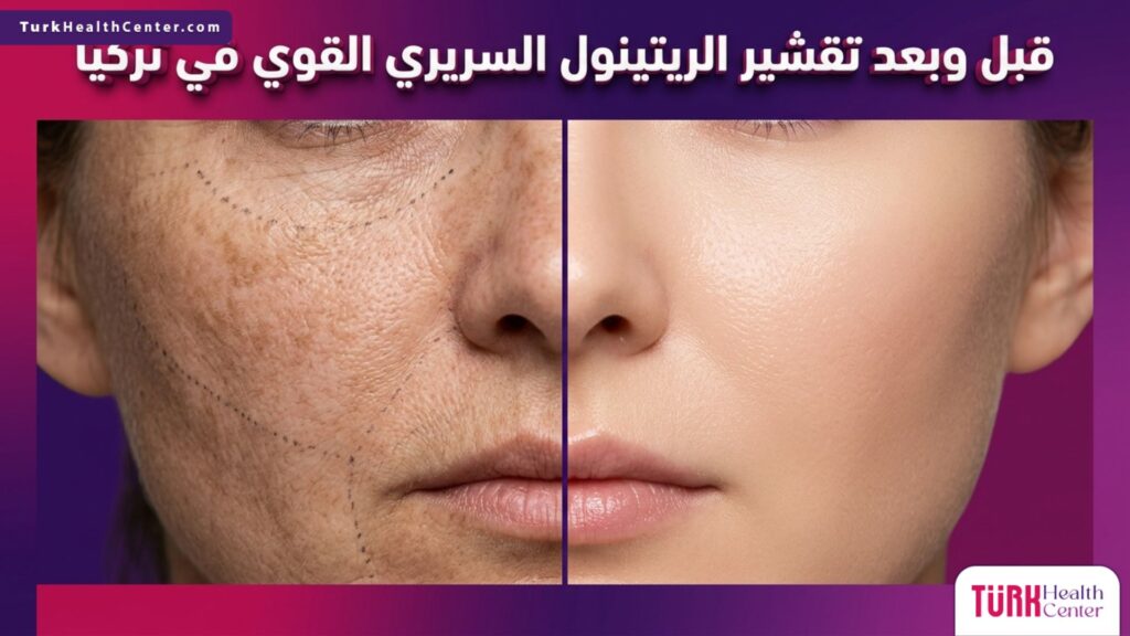 مقارنة قبل وبعد تقشير الريتينول السريري القوي في تركيا تظهر تحسن نسيج البشرة واختفاء التصبغات