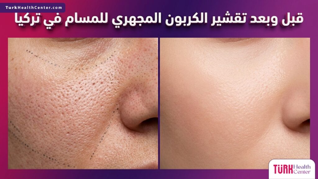 صورة مقسمة تظهر نتائج قبل وبعد تقشير الكربون المجهري للمسام في تركيا على نضارة البشرة.