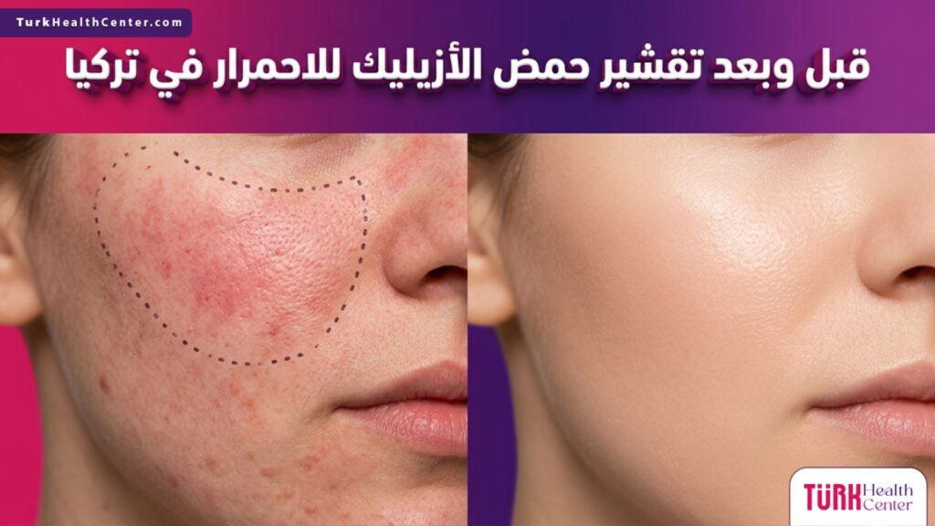 مقارنة قبل وبعد توضح فعالية تقشير حمض الأزيليك للاحمرار في تركيا في علاج تهيج البشرة واستعادة نضارتها.
