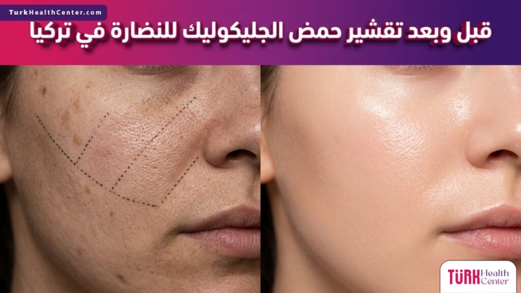 مقارنة واقعية قبل وبعد تظهر نتائج تقشير حمض الجليكوليك للنضارة في تركيا على ملمس وإشراق البشرة.