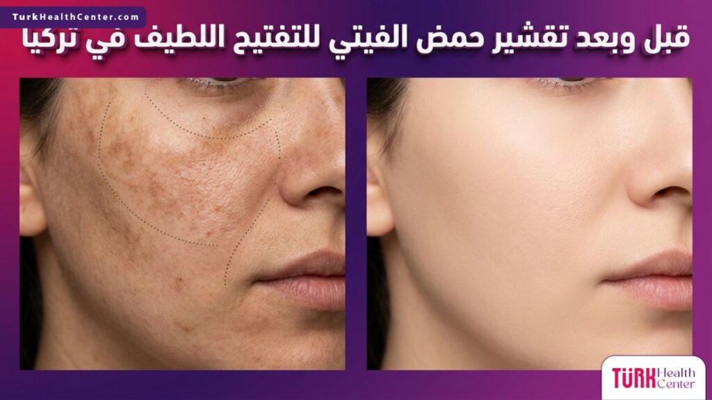 مقارنة قبل وبعد تظهر نتائج تقشير حمض الفيتي للتفتيح اللطيف في تركيا وتوحيد لون البشرة