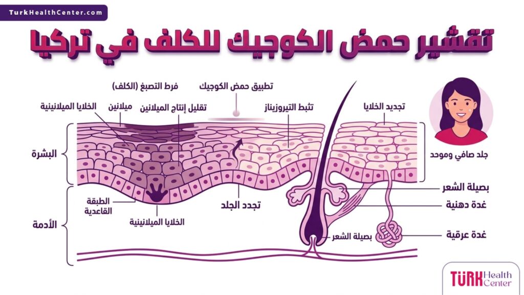 إنفوجرافيك طبي يوضح علمياً طريقة عمل تقشير حمض الكوجيك للكلف في تركيا في طبقات الجلد