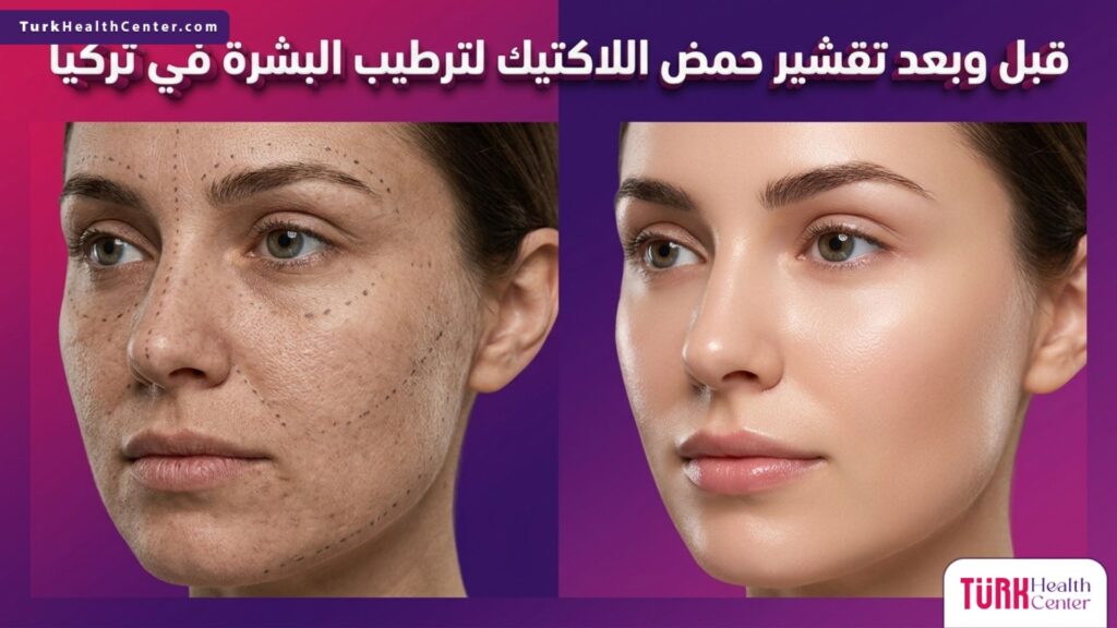 مقارنة قبل وبعد تظهر نتائج تقشير حمض اللاكتيك لترطيب البشرة في تركيا