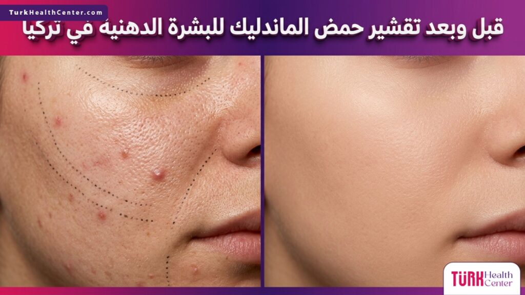 صورة قبل وبعد توضح نتائج تقشير حمض الماندليك للبشرة الدهنية في تركيا وتأثيره على المسام وتوازن إفراز الدهون.