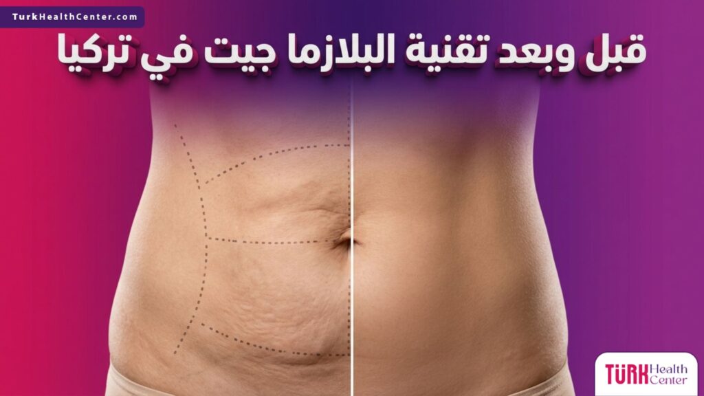 صورة مقسمة تظهر حالة الترهل قبل الإجراء والجلد المشدود بعد استخدام تقنية البلازما جيت في تركيا.