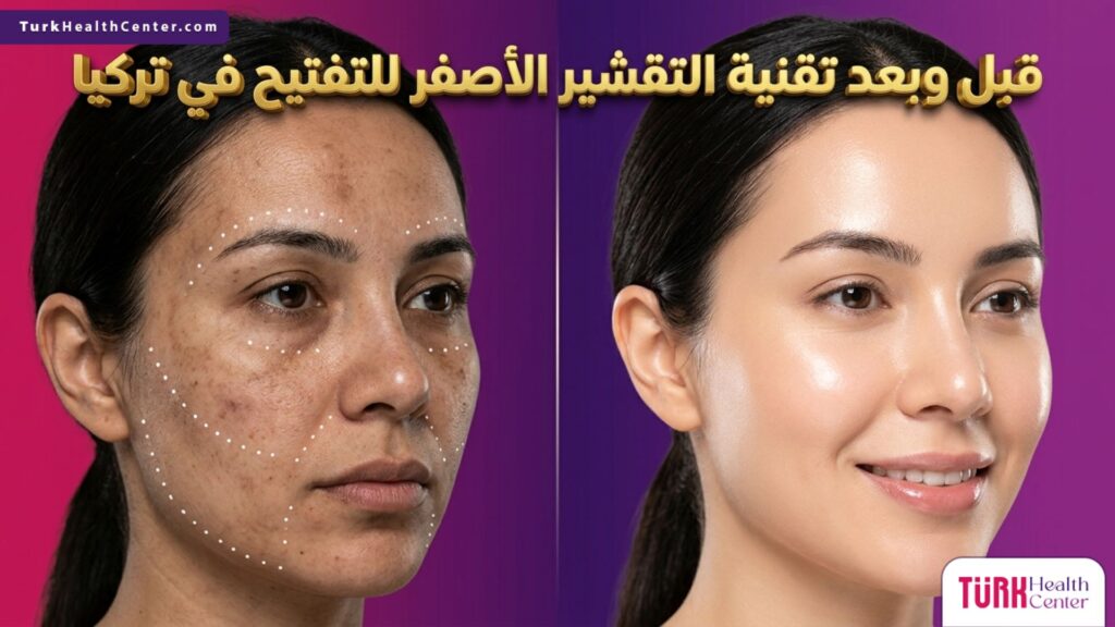 صورة مقسمة قبل وبعد توضح نتائج تقنية التقشير الأصفر للتفتيح في تركيا في إزالة التصبغات.