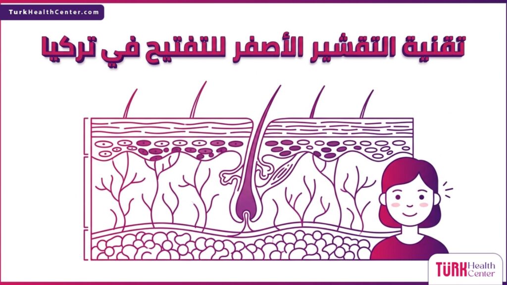 رسم توضيحي تشريحي يوضح آلية عمل تقنية التقشير الأصفر للتفتيح في تركيا داخل طبقات الجلد.