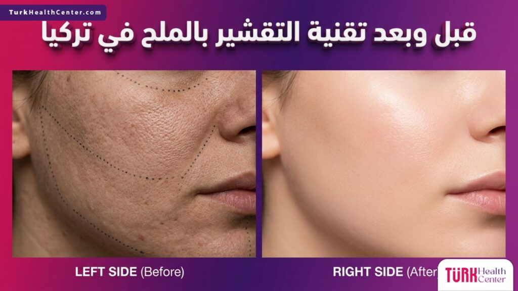 مقارنة قبل وبعد لتأثير تقنية التقشير بالملح في تركيا على نعومة ونضارة البشرة