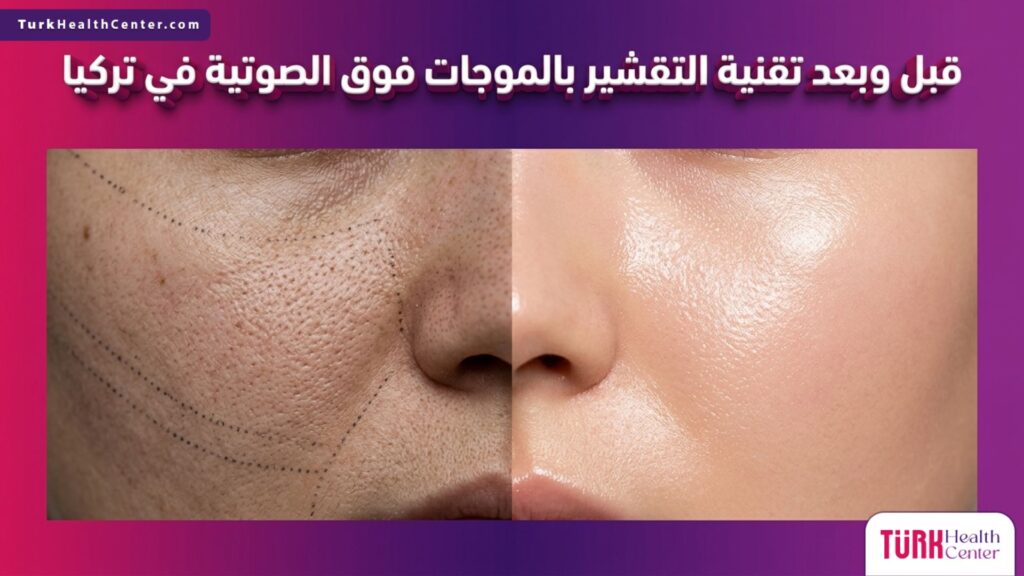 مقارنة قبل وبعد تظهر نتائج تقنية التقشير بالموجات فوق الصوتية في تركيا على نضارة ونقاء البشرة
