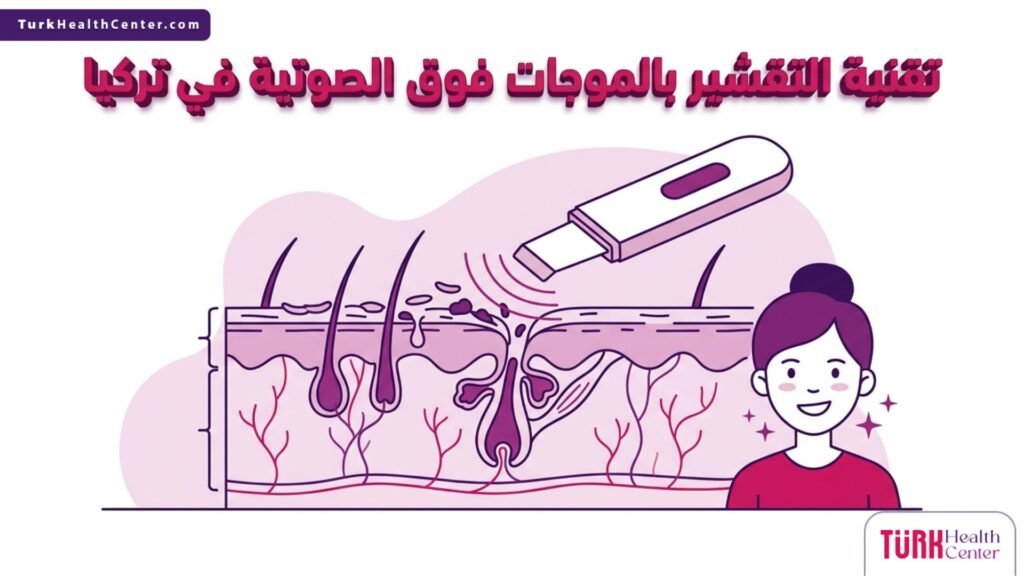 رسم تشريحي دقيق يوضح آلية عمل تقنية التقشير بالموجات فوق الصوتية في تركيا داخل طبقات الجلد