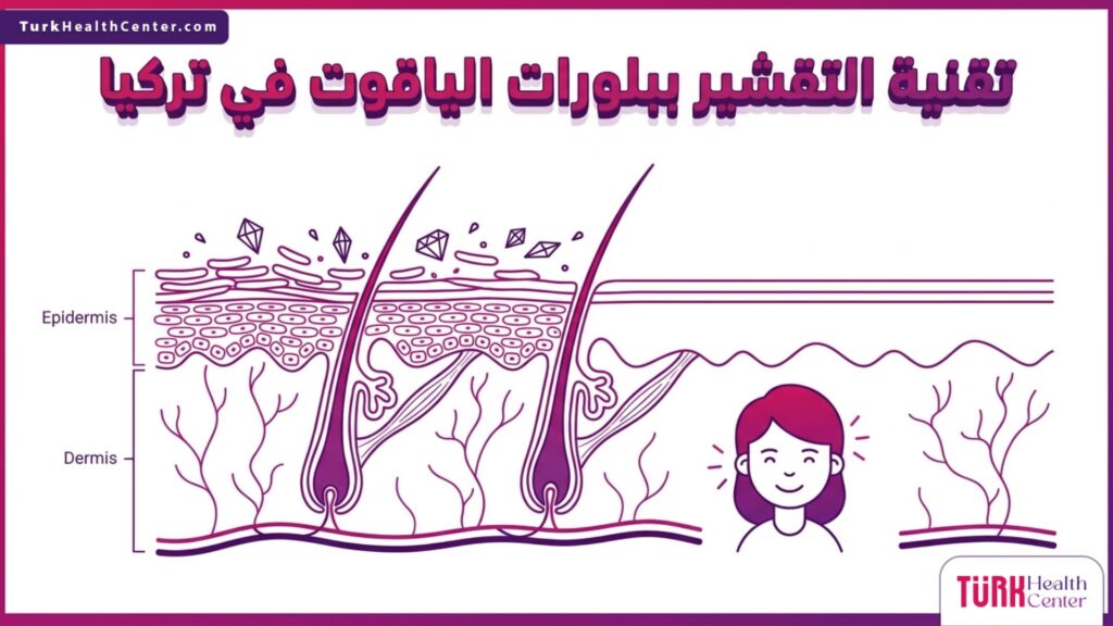 مخطط إنفوجرافيك طبي دقيق يوضح الطبقات التشريحية للبشرة وكيفية عمل تقنية التقشير ببلورات الياقوت في تركيا لتجديد الخلايا.
