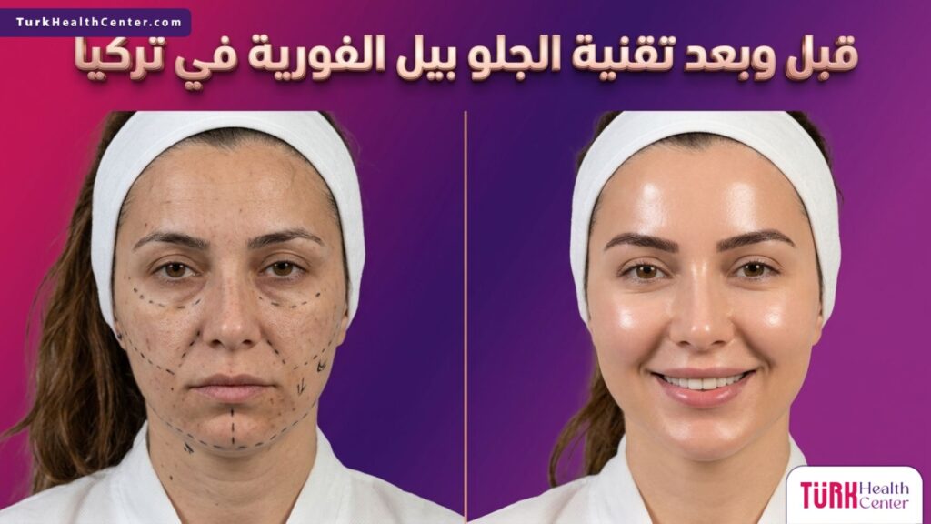 مقارنة قبل وبعد تظهر نتائج نضارة البشرة بعد استخدام تقنية الجلو بيل الفورية في تركيا
