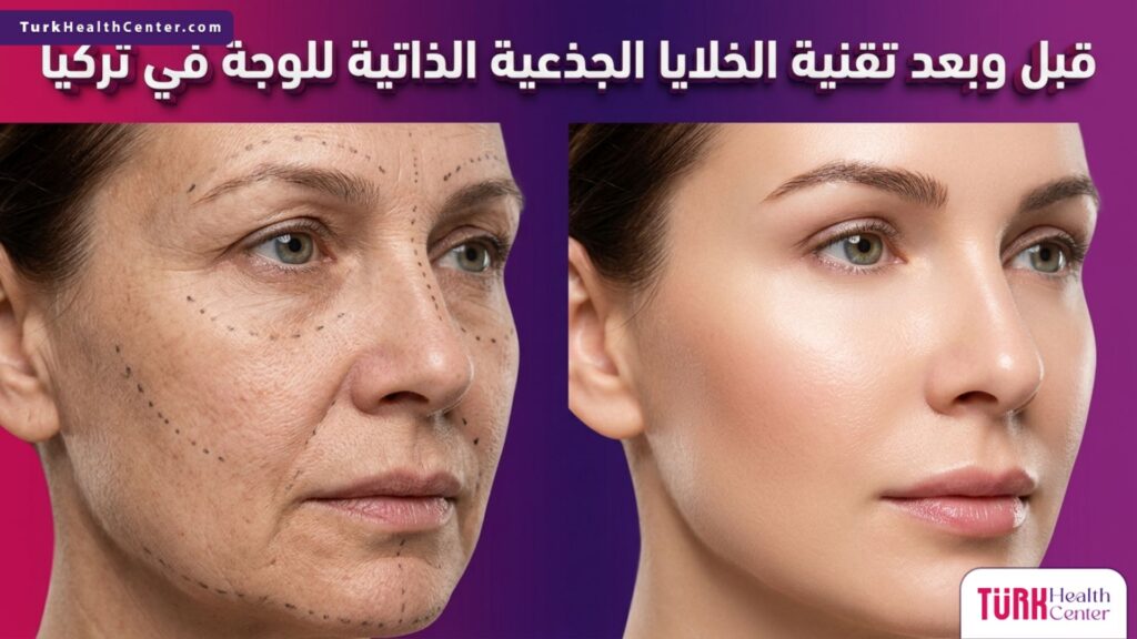 مقارنة تظهر نتائج قبل وبعد تطبيق تقنية الخلايا الجذعية الذاتية للوجه في تركيا لتجديد شباب البشرة.