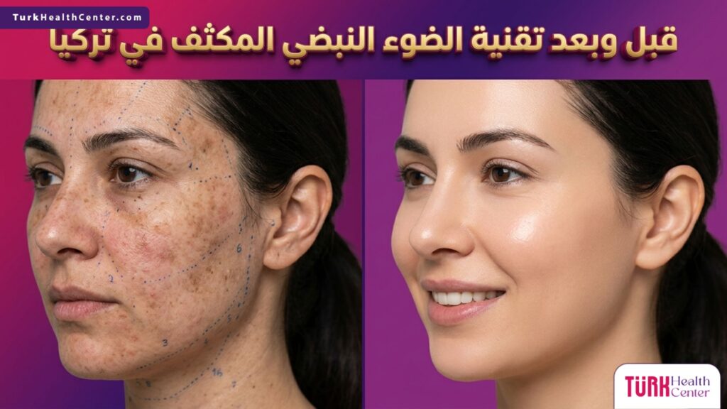 مقارنة قبل وبعد تقنية الضوء النبضي المكثف في تركيا تظهر تحسن ملمس البشرة واختفاء التصبغات.